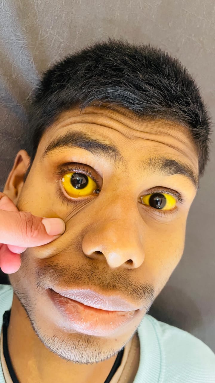 Before Jaundice Treatment